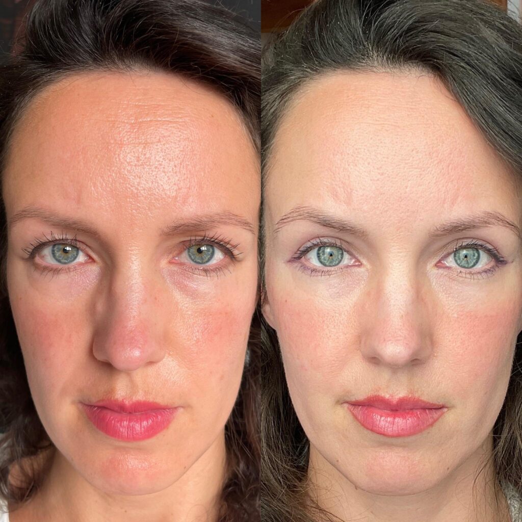 upper-blepharoplasty-4-week-post-op-results-my-experience-v0-cpvlaanx346d1