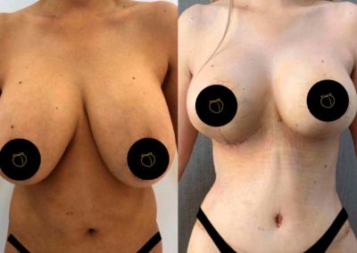 drgudalajara-before-and-after-8-400×284-1