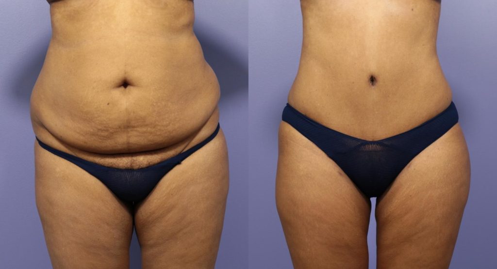 tummy-tuck-1180-view-1-thumbnail-1